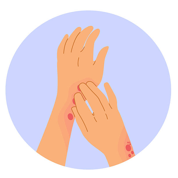 Cartoon Vector of Female Hands Scratching Skin Rash Illustration A cartoon vector showing close-up of female hands scratching irritated skin with rash, perfect for dermatology, skincare or medical awareness content chicken pox virus stock illustrations