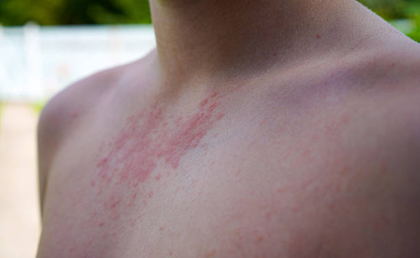 istock Close-up Allergic rash dermatitis eczema on skin. 2226509505