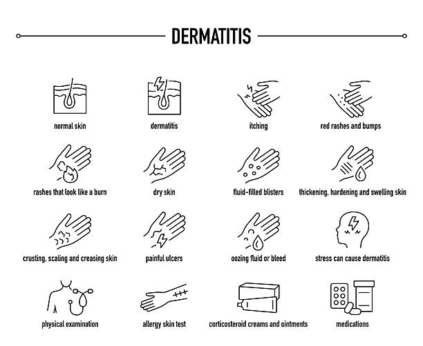 ilustraciones, imágenes clip art, dibujos animados e iconos de stock de conjunto de iconos vectoriales de síntomas de dermatitis, diagnóstico y tratamiento - irritación