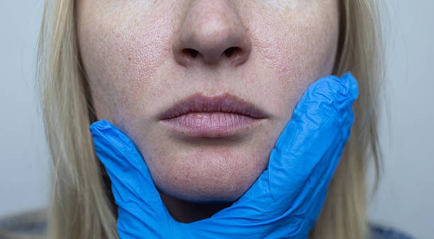 istock A dermatologist examines a woman's face with dilated pores, pigmentation, and sebaceous filaments. Treatment of rosacea and skin inflammation. 2226659531