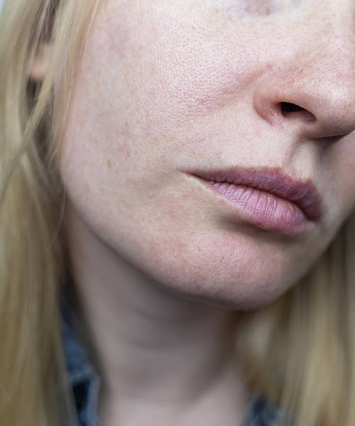 istock A dermatologist examines a woman's face with dilated pores, pigmentation, and sebaceous filaments. Treatment of rosacea and skin inflammation. 2226659541