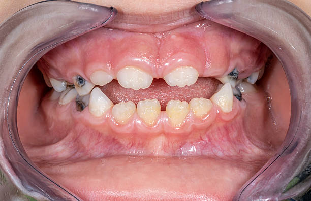 istock Front view of a young boy's dental arches, in biting occlusion 2226671561