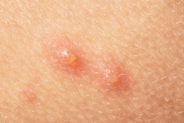 istock Chickenpox (Varicella) on the skin close-up 2226695700