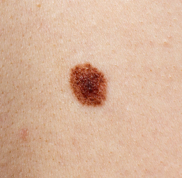 istock A small brown spot on a person's arm 2226750875