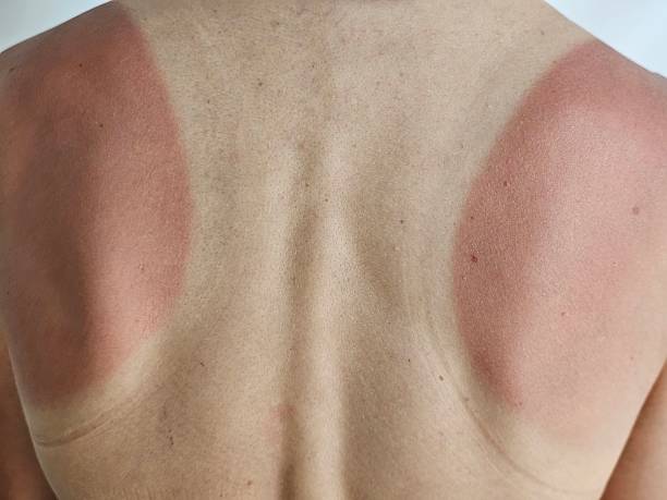istock Sunburnt back showing red patches after a day outdoors, showcasing skin 2226756087