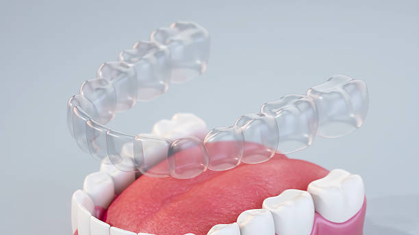 Clear aligners placed on a dental model, showcasing teeth straightening process and orthodontic treatment options