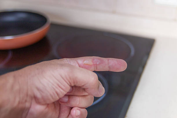 istock Finger burn blister from hot stove 2226994254