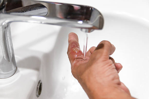 istock Burn blister treatment under running water 2226994257