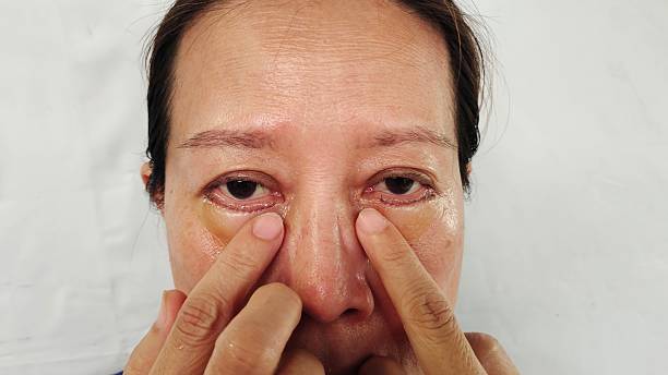 istock Facelift and lifting, Under eye fat removal and Reposition. 2227041544