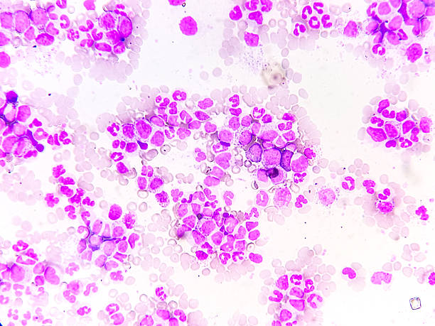 istock Chronic myeloproliferative neoplasm. 2227062136