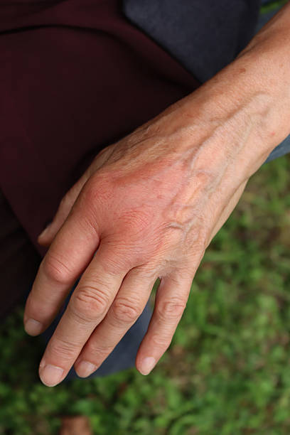 istock Close-up of elderly woman’s hand swollen from a wasp sting 2227215310