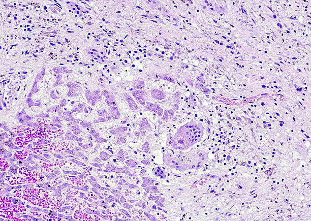 istock Micrograph of Liver Sarcoidosis 2227263808