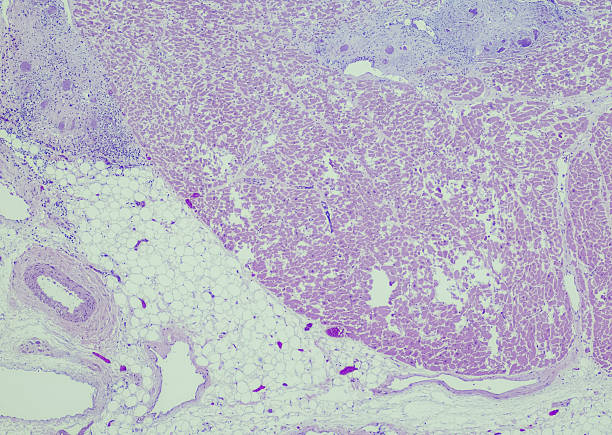 istock Micrograph of cardiac sarcoidosis 2227263839