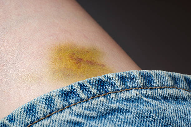 istock Bruise on the leg - healing hematoma. 2227377128