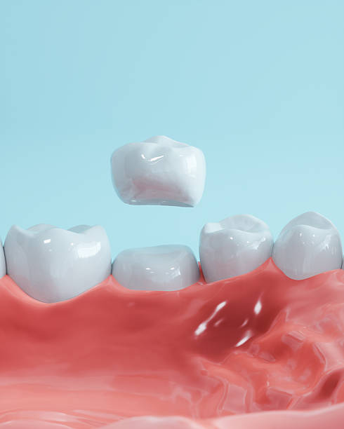 istock 3D Model Of Dental Crown Being Placed On A Tooth 2227664688