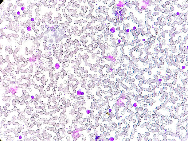 istock Abnormal blood picture. Complete blood count, WBC, CBC, microscopic view. 2228061756