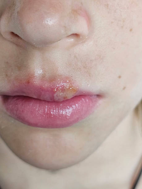 istock Comparison of lip condition after injury 2228129312