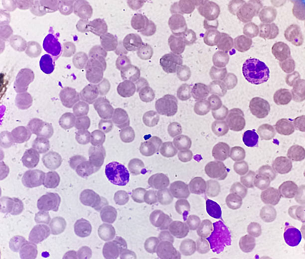 istock Chronic lymphoproliferative disease. Complete blood count microscopic view. 2228734678
