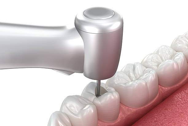 istock Making access to the root canal. 3D illustration 2228749477