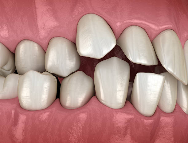 istock Overcrowded teeth, abnormal dental occlusion. Medically accurate tooth 3D illustration 2228749493