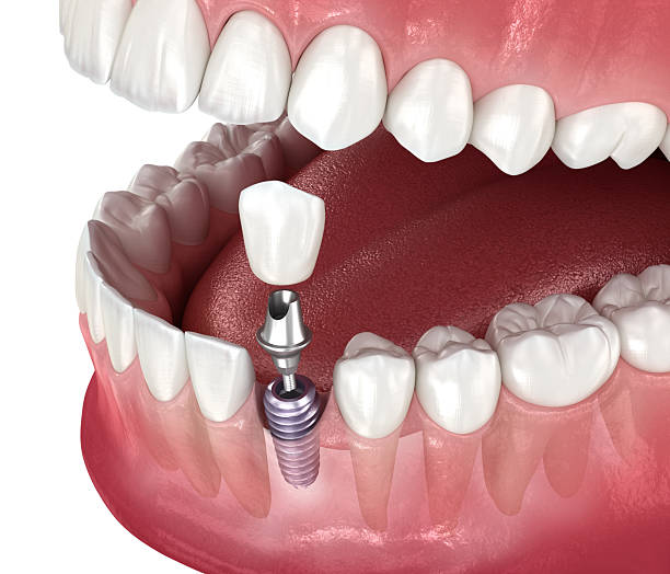 istock Dental implant and ceramic crown. 3D illustration. 2228749583