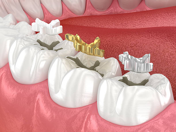 istock Dental fillings: ceramic, golden, metal. Dental 3D illustration 2228758814
