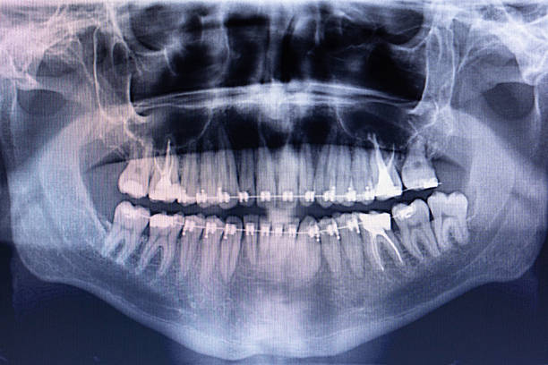 istock Panoramic dental x-ray image of patient with braces 2228926707
