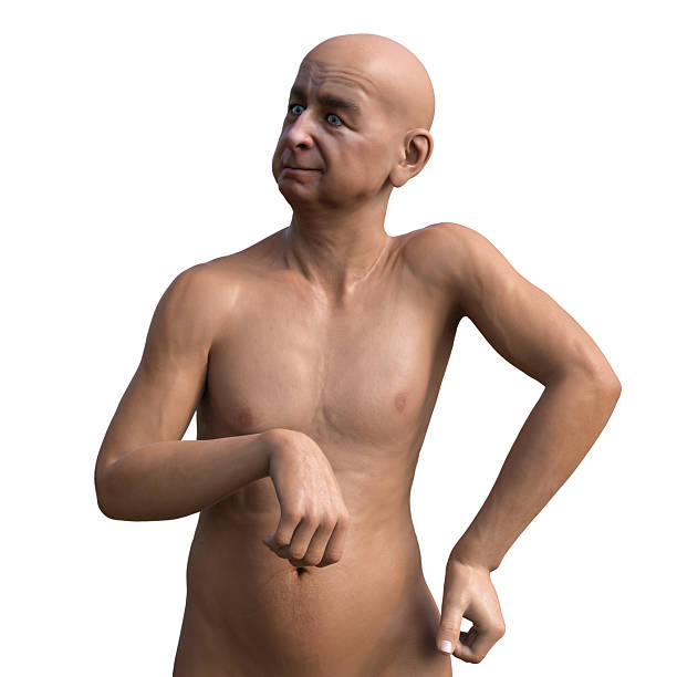A person with Huntington's chorea, a neurodegenerative disease due to mutation in the HTT gene, changes in brain basal ganglia leading to random uncontrollable movements and dementia, computer illustration.