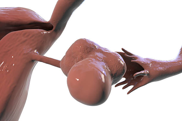 Polycystic ovary syndrome. Computer illustration showing enlarged ovary with cysts.