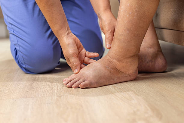 Elderly woman has edema or swelling foot.