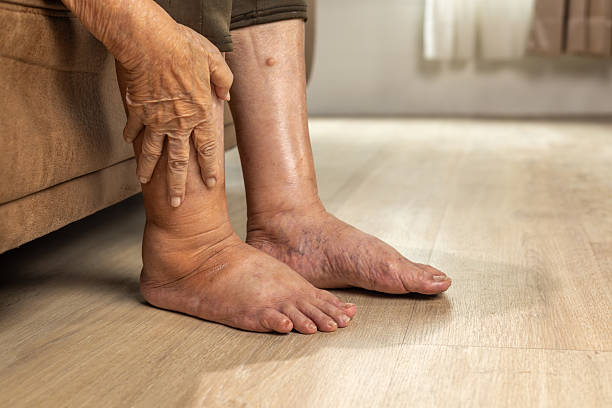 istock Elderly woman has edema or swelling foot. 2229013565