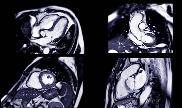 istock MRI heart stress test revealing detailed cardiac function under controlled conditions, aiding in early diagnosis and High-resolution imaging captures heart performance during stress. 2229176410