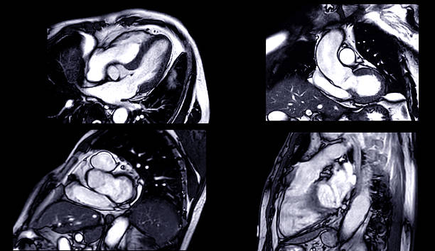 istock MRI heart stress test revealing detailed cardiac function under controlled conditions, aiding in early diagnosis and High-resolution imaging captures heart performance during stress. 2229176469