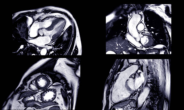 istock MRI heart stress test revealing detailed cardiac function under controlled conditions, aiding in early diagnosis and High-resolution imaging captures heart performance during stress. 2229176551
