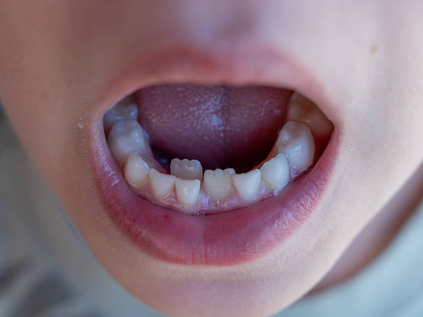 istock Close up of a child's open mouth revealing ectopic eruption (two row teeth) and missing milk teeth, highlighting the process of dental development and tooth loss during childhood 2229412111