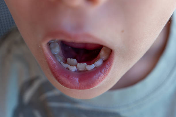 istock Child's mouth revealing transitioning dentition, two row teeth or ectopic eruption, with permanent teeth emerging while baby teeth disappear, representing dental development stages 2229412112