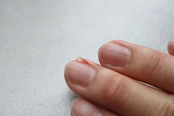 istock A painfully broken middle finger nail. 2229448718