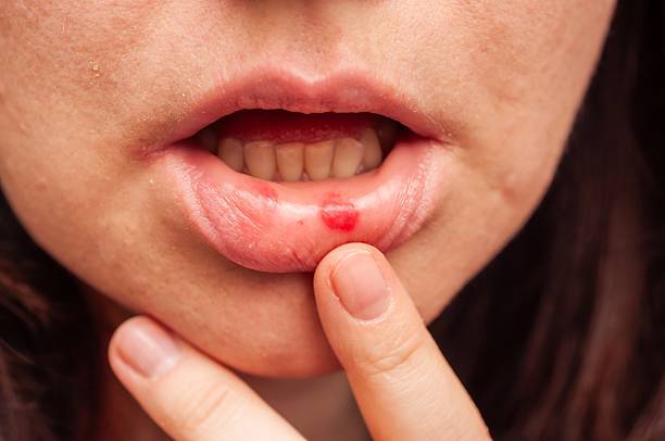 istock A close-up shows a cold sore on a person's lip, highlighted by a finger's gentle touch. 2229573091