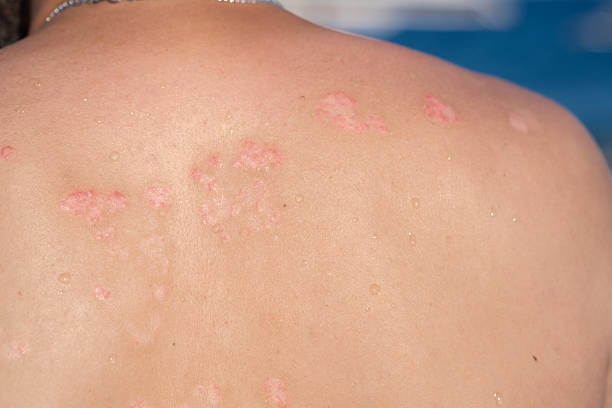 istock Skin Condition Visible on Back With Red Patches Indicating Psoriasis During Warm Weather 2229661974