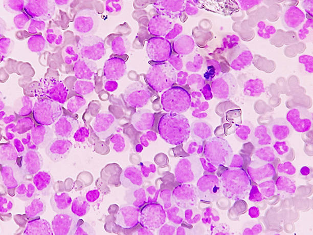 istock Chronic myeloproliferative neoplasms. Complete blood count microscopic view. 2229811612