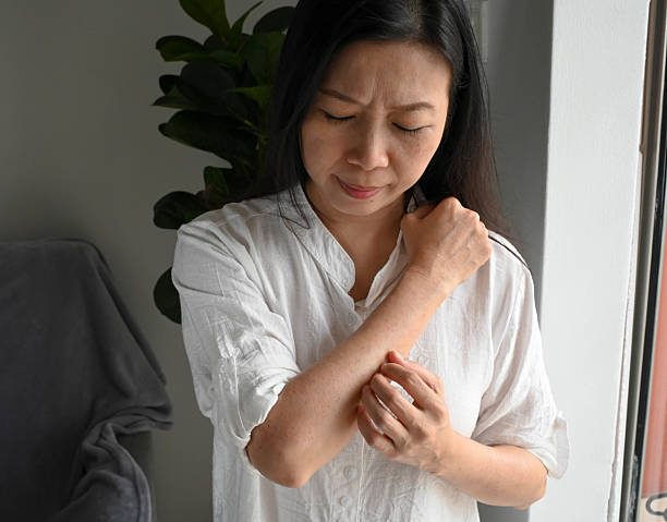 istock Close-Up of Itching Red Rash on Thigh 2229905736