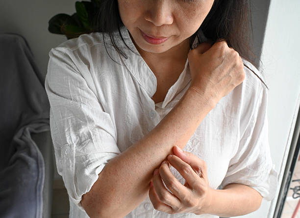istock Skin Disorder Concept: Rash on Female Thigh 2229905739