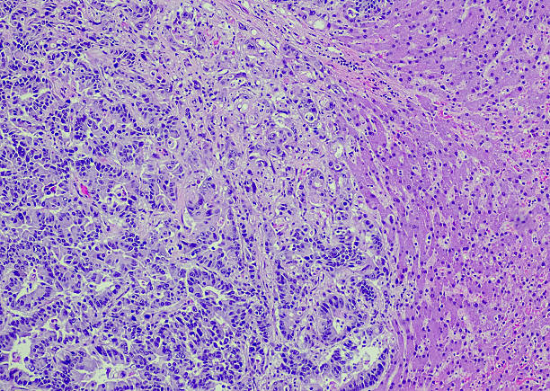 istock Adenocarcinoma metastatic liver 2230033384