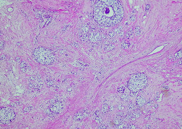 istock Invasive breast carcinoma of no special type 2230033471