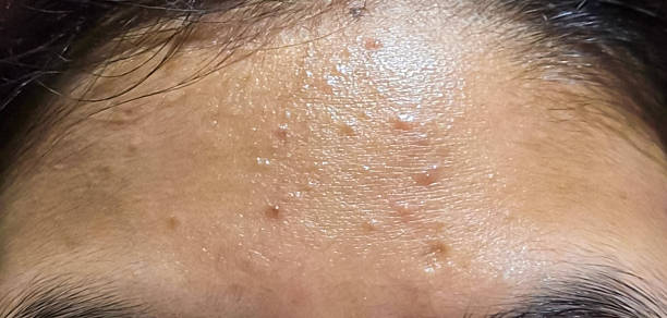 istock Closeup view of pimples and acne on forehead. 2230079382