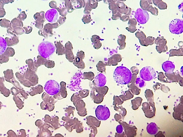 istock Chronic myeloproliferative neoplasms. Complete blood count microscopic view. Myelocyte and metamyelocyte. 2230228088