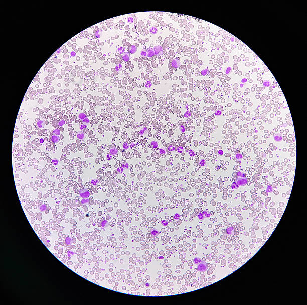 istock Chronic myeloproliferative neoplasms. Complete blood count microscopic view. 2230228107