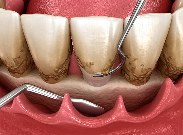 Open curettage: Scaling and root planing (conventional periodontal therapy). Dental 3D illustration