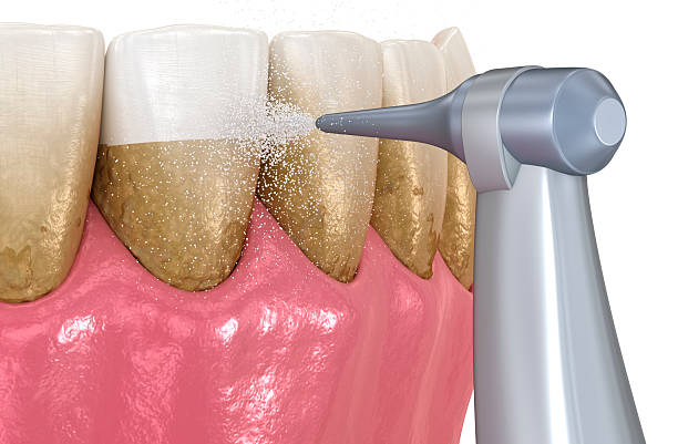 istock Oral hygiene: Air flow teeth cleaning process. Dental 3D illustration 2230245278