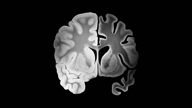 Alzheimer Left Hemisphere Brain Coronal Slice Comparison Alzheimer left hemisphere compared to healthy right hemisphere in a coronal brain slice with cortical thinning, widened sulci, enlarged ventricles and progressive brain tissue loss. cerebral cortex stock pictures, royalty-free photos & images